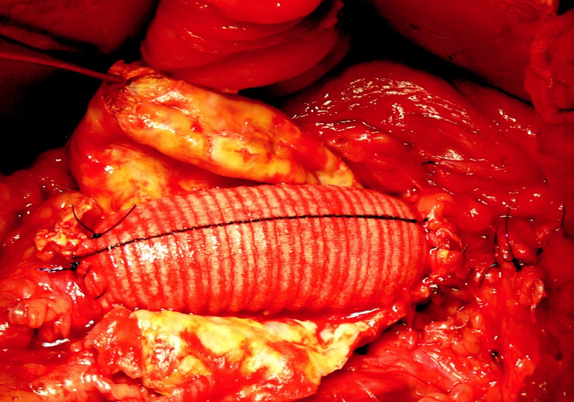 5. Resekce AAA s A-A náhradou z extraperitoneálního přístupu
Fig. 5. Resection of the AAA with A-A implantation performed using the extraperitoneal approach