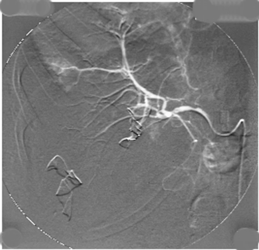 Angiografie jater s únikem kontrastní látky z pravé větve jaterní tepny