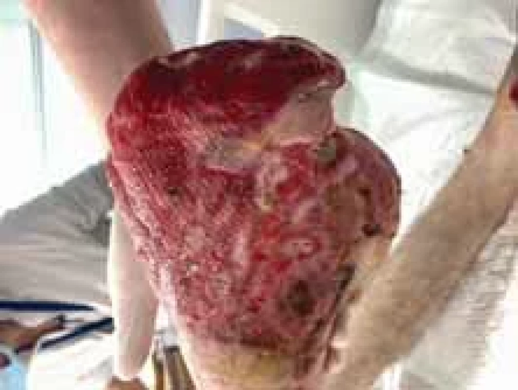 The appearance of right foot after amputation and removal of debridement (lateral view).