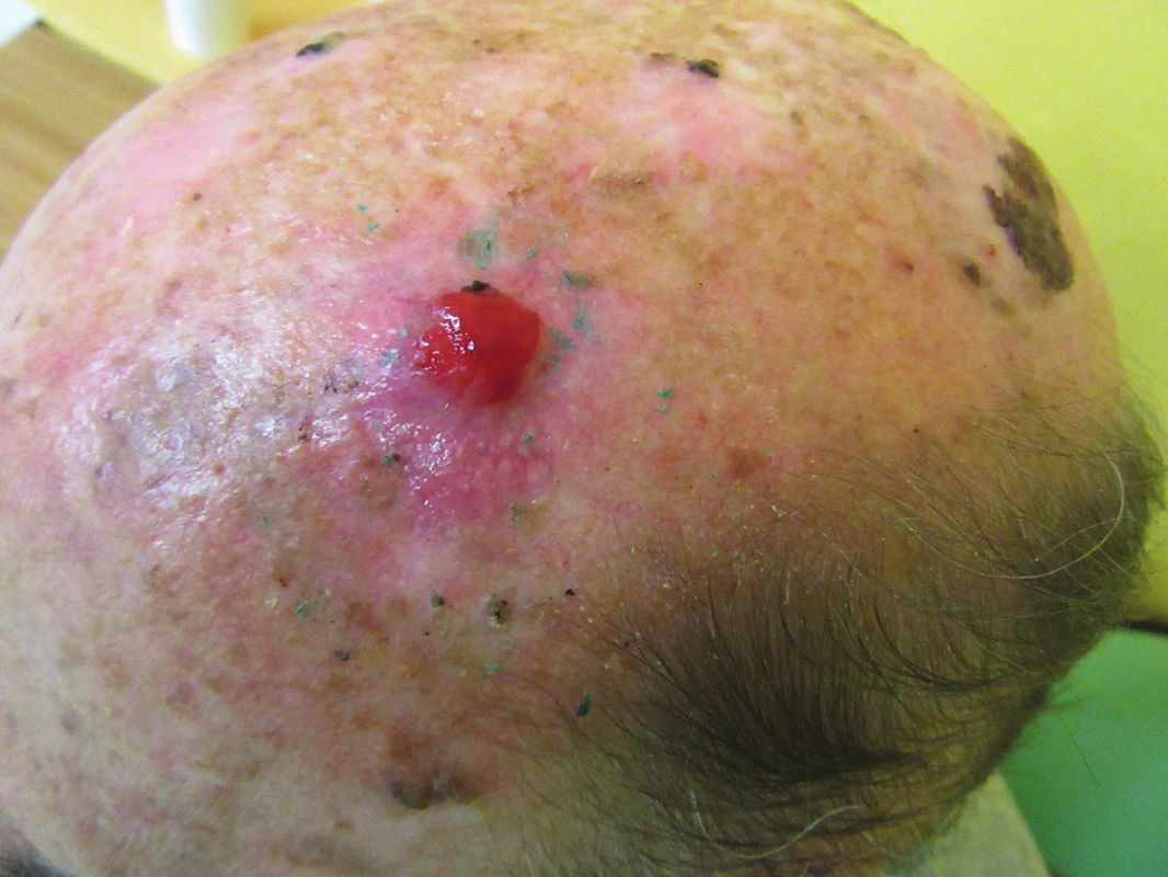 Klinický obraz v říjnu 2015 – růžový lesklý tumor na temeni hlavy