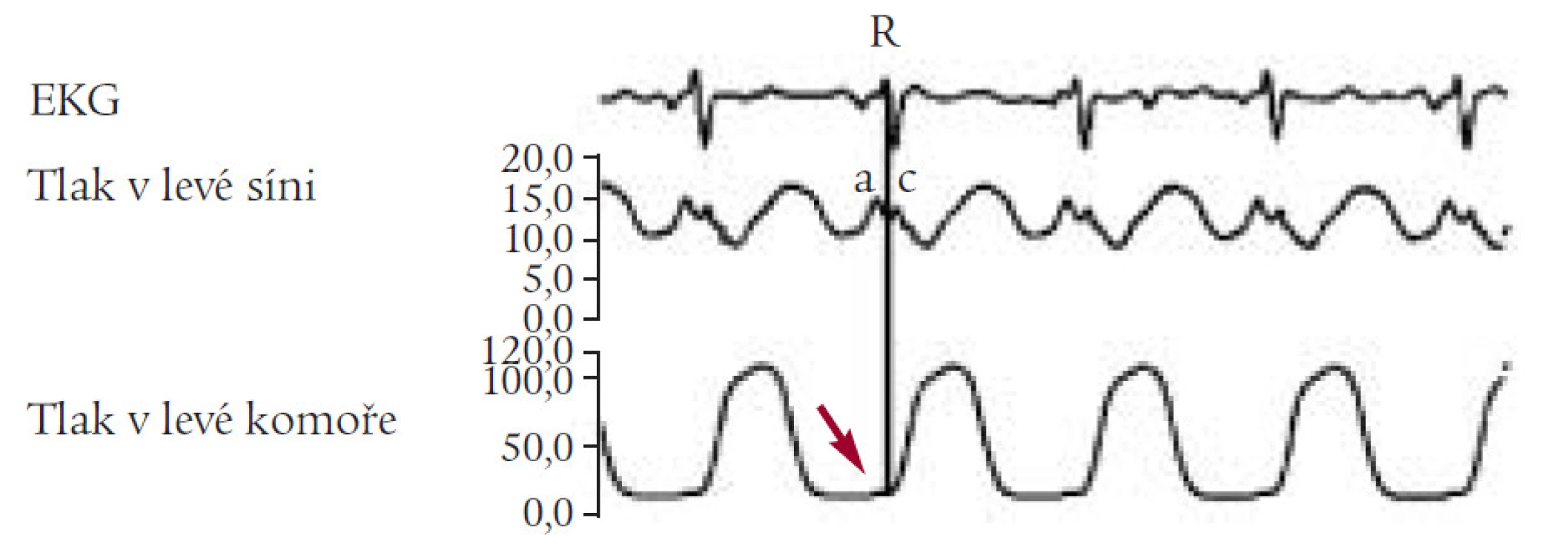 Enddiastolický tlak v levé komoře (LVEDP).
