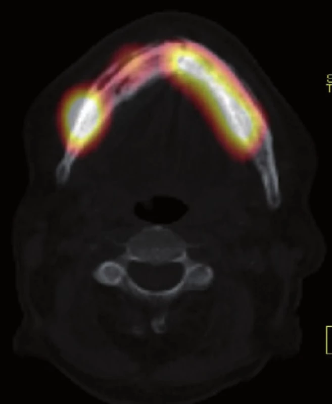 SPECT/CT vyšetření u pacienta z obr. 1, axiální řez – fúzní zobrazení patologicky zvýšeného kostního metabolického obratu a strukturálních změn dolní čelisti. (Zdroj obr.: Klinika zobrazovacích metod LF UK a FN Plzeň)