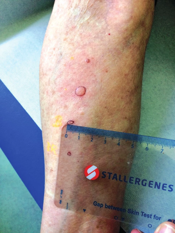 Pozitivní reakce na sugammadex – vznik kožního pupenu o průměru 5 mm