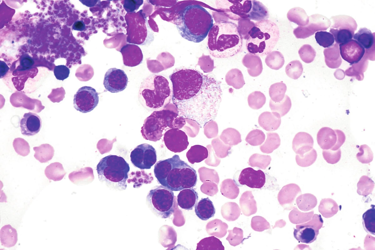 Morfologické atypie erytropoézy (vícejaderné normoblasty, mezijaderné můstky) u nemocné s kongenitální dyserytropetickou anémií II. typu