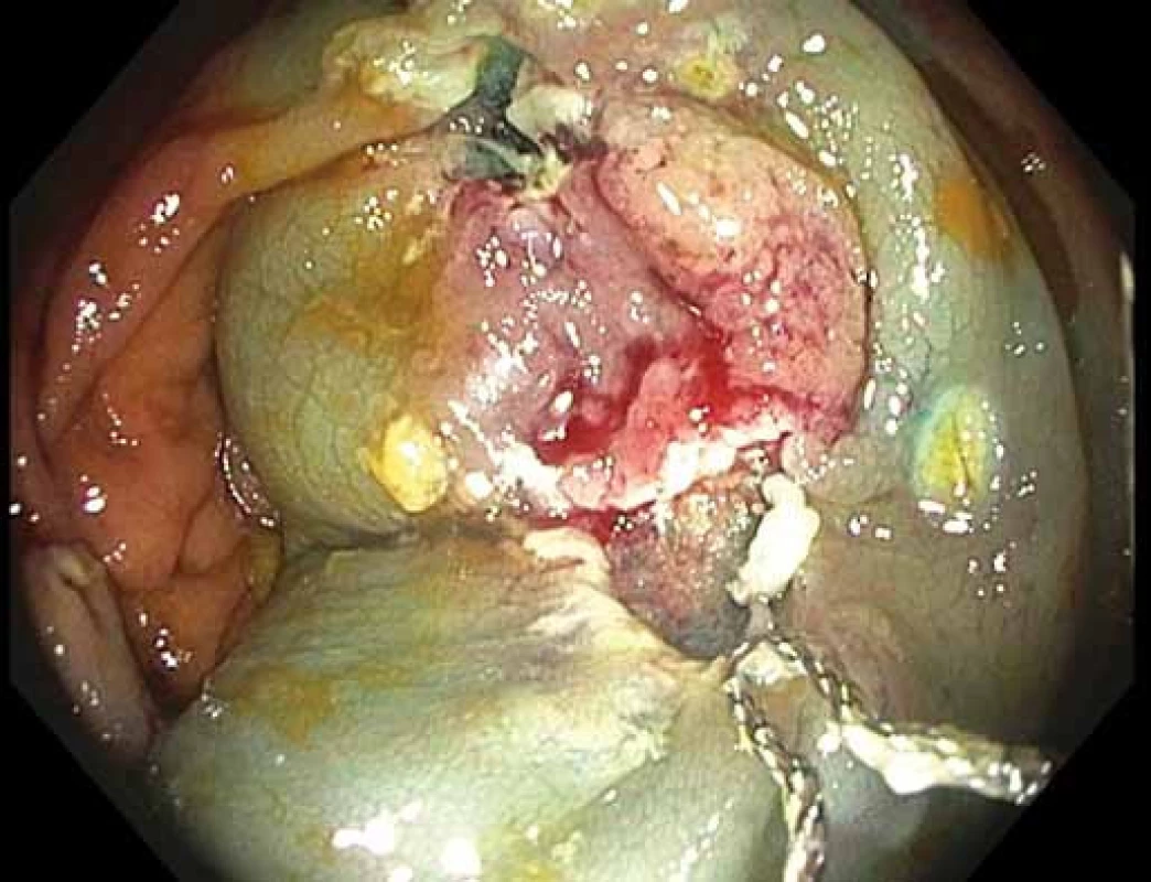Endoskopická slizniční resekce okrajových částí léze s příznakem „liftingu“.
Fig. 4. Endoscopic mucosal resection of lifted marginal parts of the lesion.