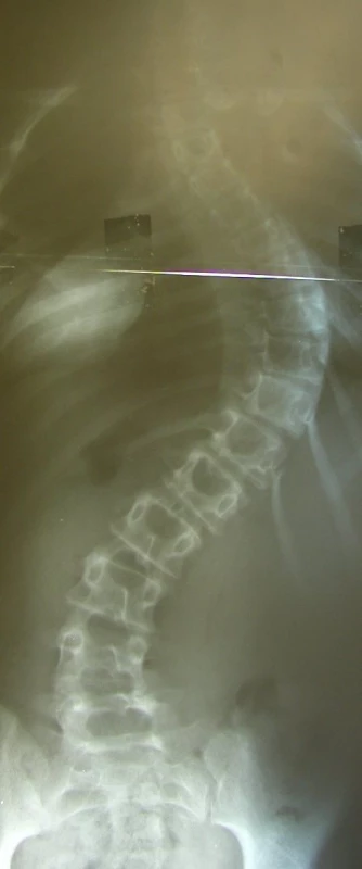 Rtg snímek skoliózy páteře před operací zadním přístupem