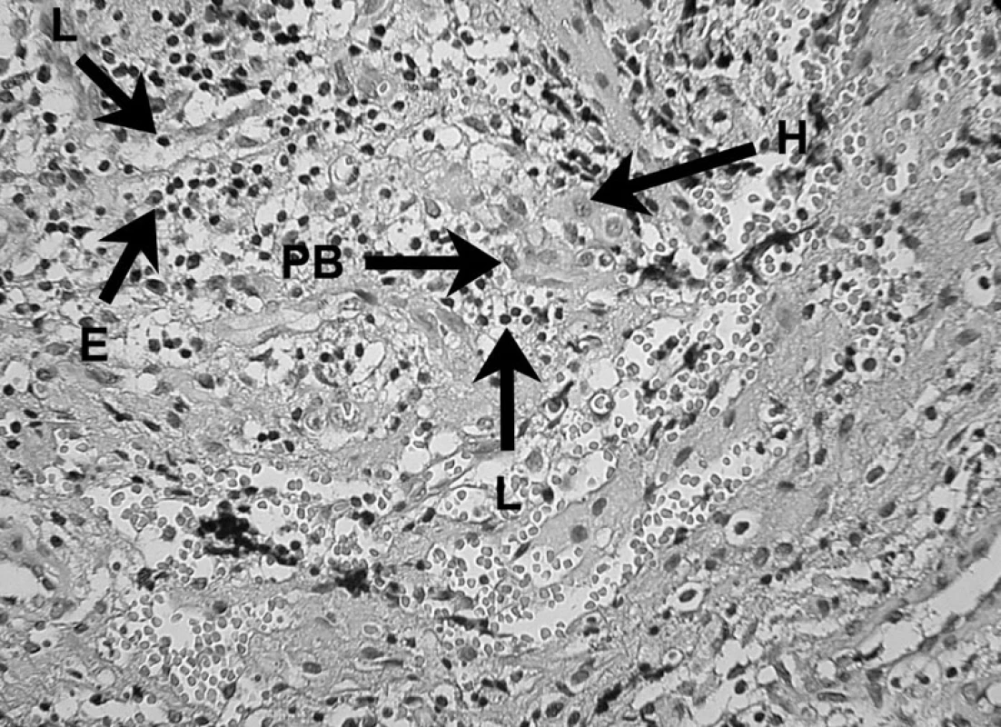 Zápalový bunkový infiltrát prítomný v periapikálnom granulóme V histopatologickom obraze lézie možno vidieť lymfocyty (L), eozinofily (E), plazmatickú bunku (PB) a histiocyt (H) – autor Ján Kováč.
Fig. 8. Inflammatory cell infiltrate in periapical granuloma Histopathological image of the lesion shows lymphocytes (L), eosinophils (E), a plasma cell (PB), and a histiocyte (H) – Author Ján Kováč.