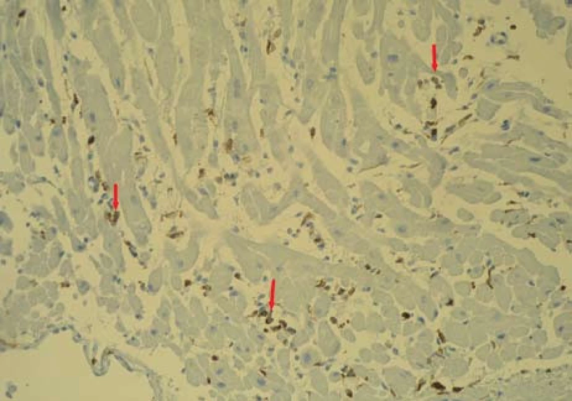 Bioptický vzorek myokardu (HE, zvětšení 200×) s ložiskem intersticiální inflamatorní reakce, těsně navazující na kardiomyocyty (označeno šipkou).
Fig. 7. Bioptic sample of the myocardium (magnification of 200×) with the nidus of interstitial inflammatory response, closely following cardiomyocytes (marked by arrow).