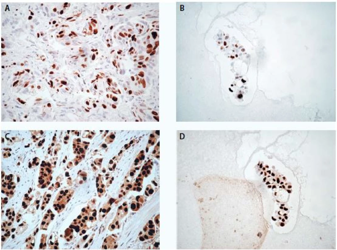 High-grade uroteliální karcinom, imunochemické vyšetření markeru Ki-67 ve tkáni (A) a v cytobloku (B)
a markeru p53 ve tkáni (C) a v cytobloku (D), zvětšení 400×<br>
Fig. 2. High-grade urothelial carcinoma, expression of Ki-67 in tissue section (A) and in cell block section (B) and
expression of p53 in tissue section (C) and in cell block section (D), magnification 400×