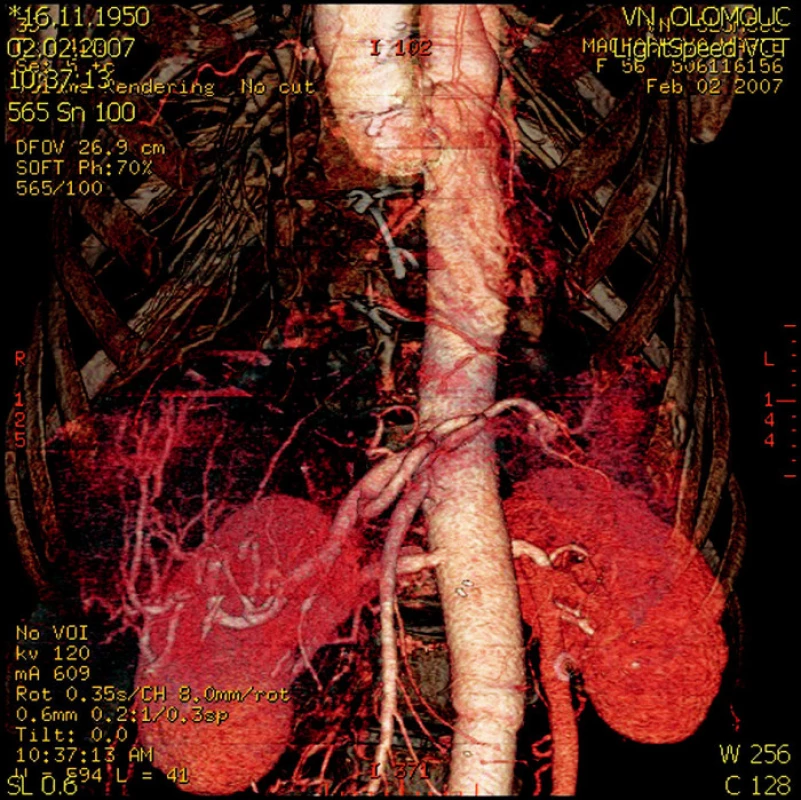 CT rekonstrukce břišní aorty – detail reimplantovaných tepen (truncus coeliacus, arteria mesenterica superior, obě renální tepny)
Fig. 5. A CT reconstruction of the abdominal aorta – a detail view of the reimplanted arteries (truncus coeliacus, arteria mesenterica superior, both renal arteries)