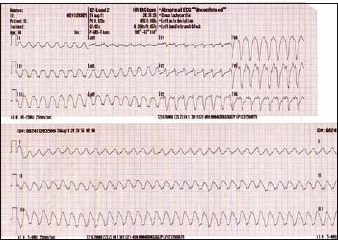 EKG záznam z monitoru na místě zásahu zachycující tachykardii se širokým QRS komplexem.