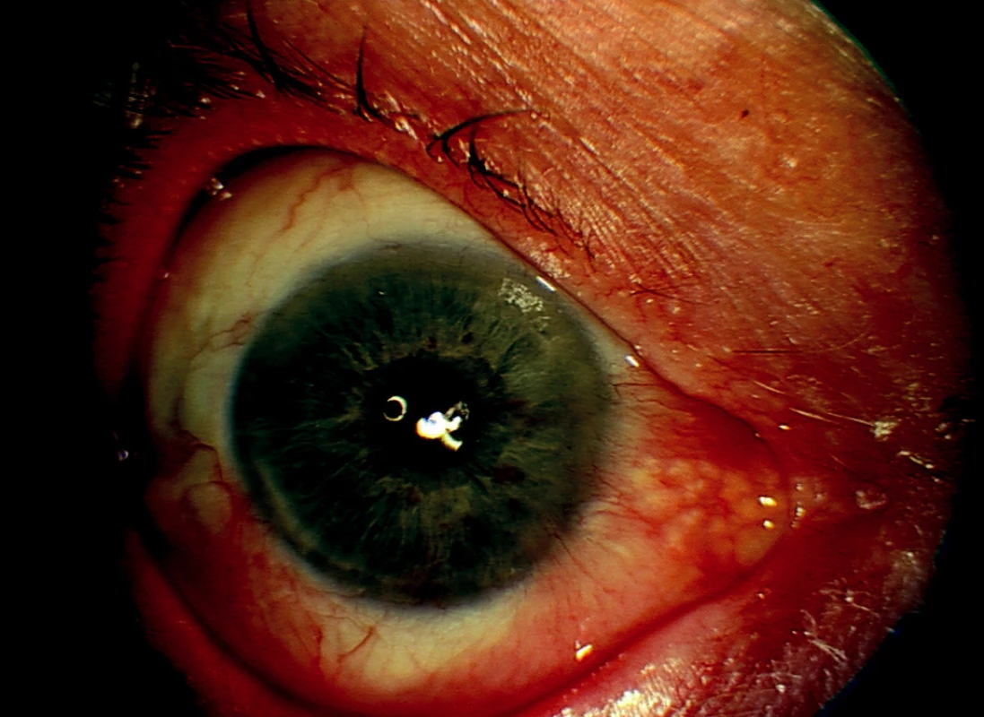 Pravé oko – 3 roky po poslední reoperaci s transplantací amniové membrány