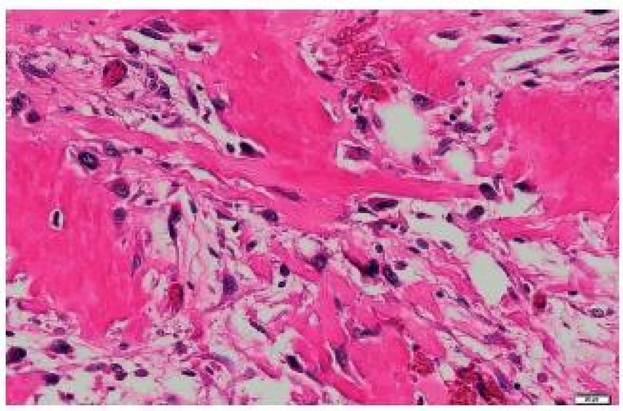 Osteosarcomatous differentiation of a malignant phyllodes tumor of the right breast. HE, scale bar 20 μm.
