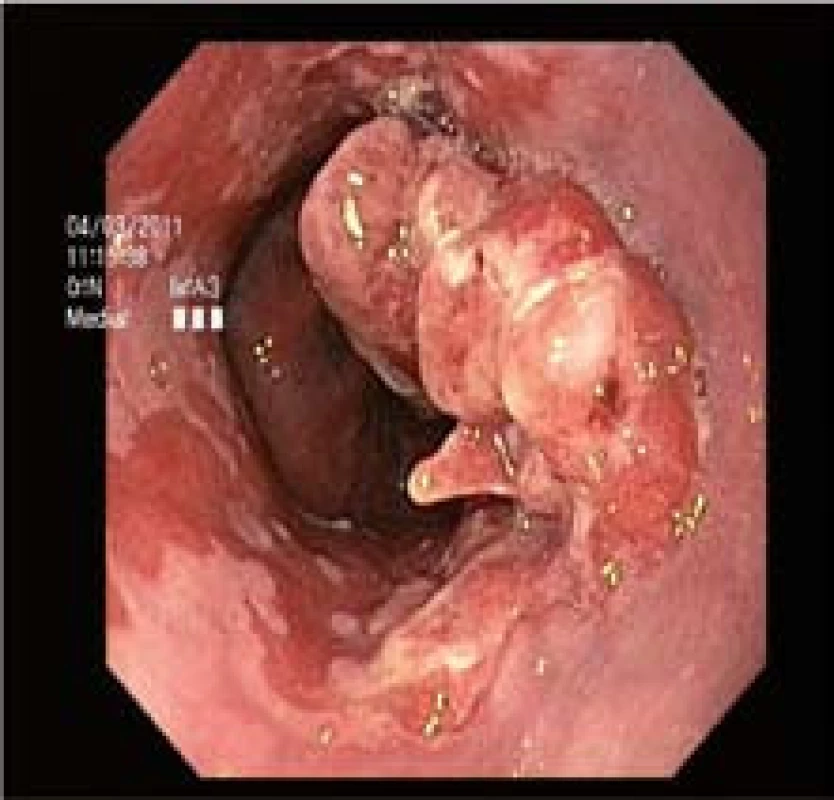 Původní makroskopický vzhled komplexní léze v terénu Barrettova jícnu.
Fig. 1. The initial complex lesion in Barrett’s esophagus.
