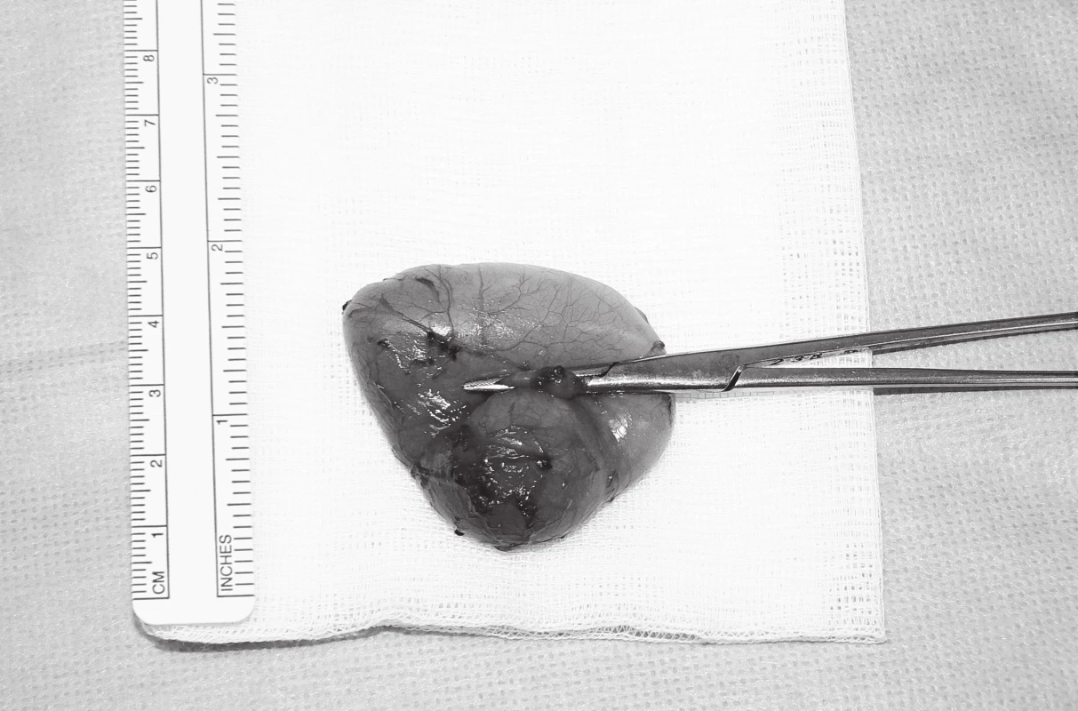 Cystický útvar s podvázanou píštělí.
Fig. 3. The thyroglossal cyst with fistula.