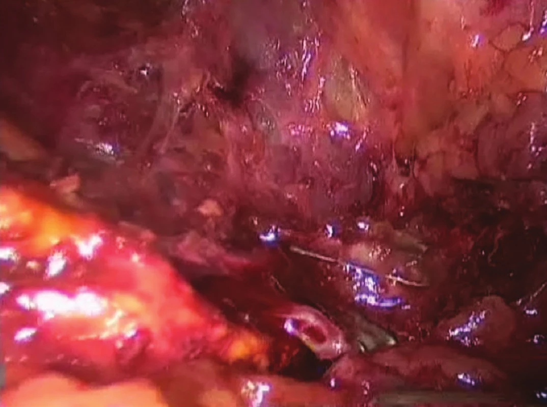 Přerušení v. suprarenalis po naložení klipů centrálně
Fig. 3: Dissection of vena suprarenalis after the central clips placement