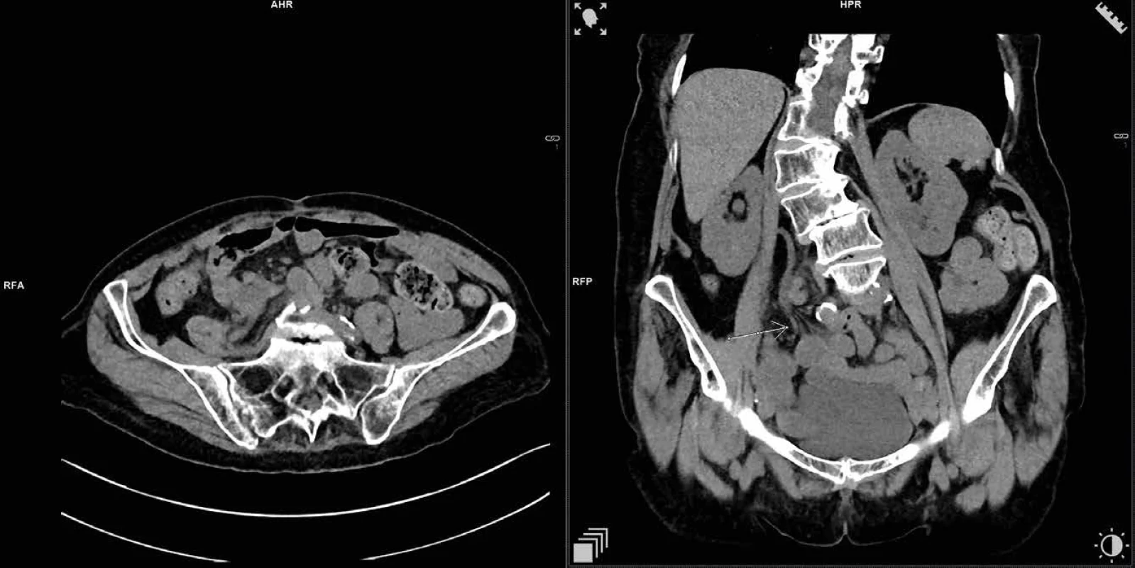 Místo stenózy pravého ureteru   Fig. 1: Location of stenosis of the right ureter