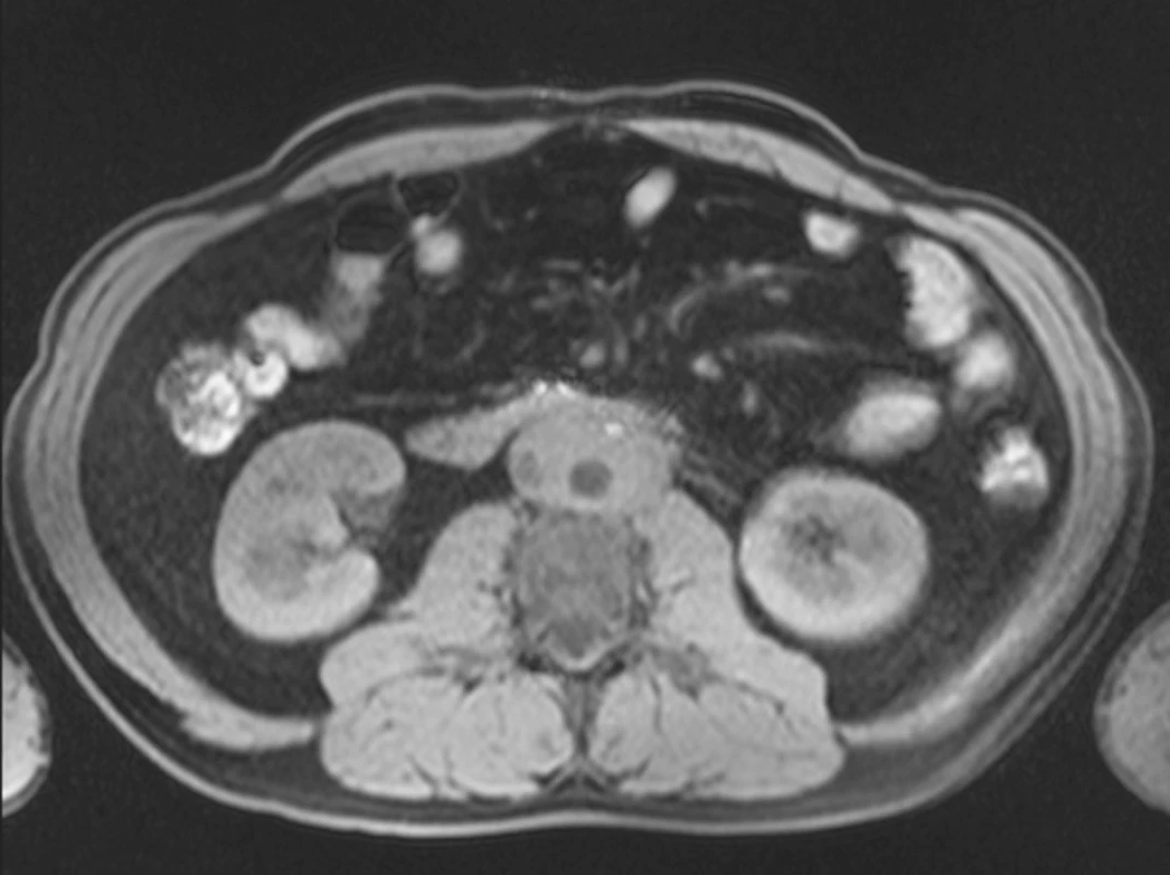 MRI prokazuje retroperitoneální fibrotické hmoty obklopující abdominální aortu, dolní dutou žílu, iliické cévy a oba uretery intenzity odpovídající svalové tkáni v obou T1W1 and T2W1 módech.