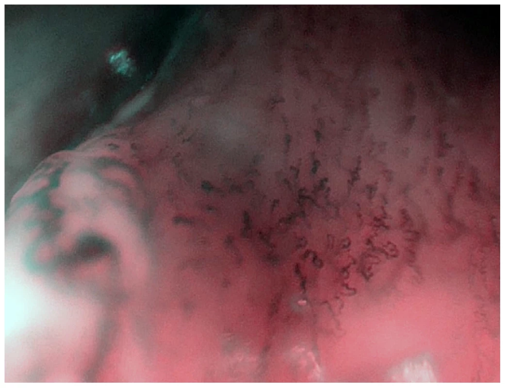 Zvětšovací NBI endoskopie – stejný nález jako na obr. 2. Detail patologické vaskularizace v okraji tumoru.