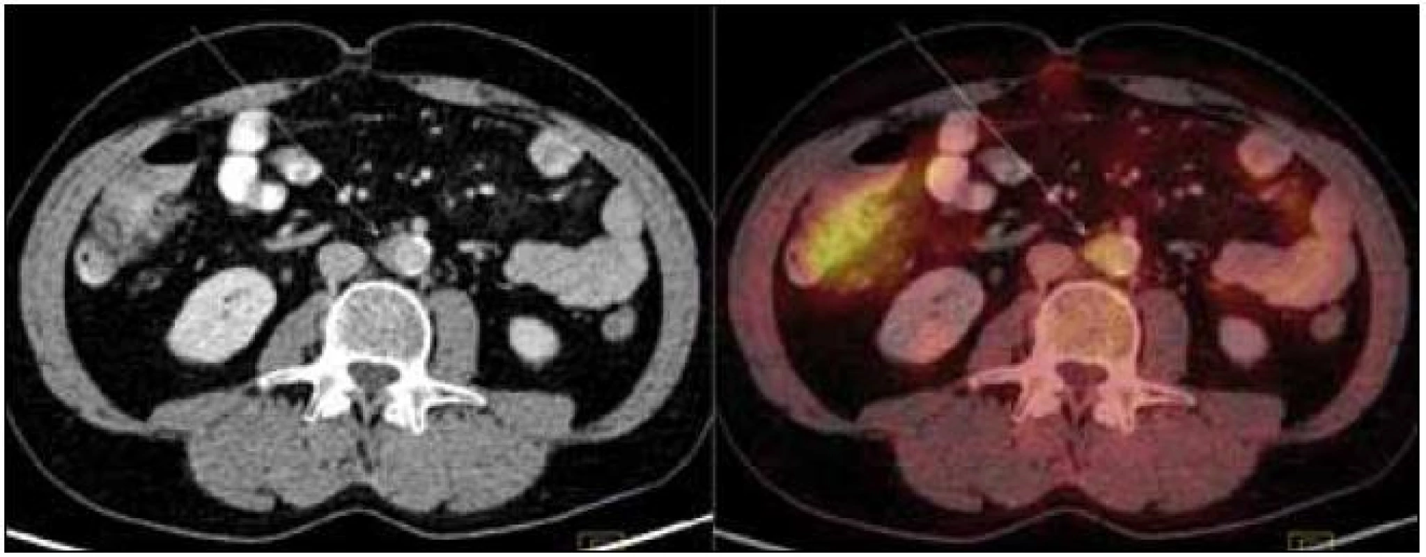 PET-CT zobrazení břicha. Zneostření zevních kontur břišní aorty a nepravidelné zesílení stěny místy až na 9 mm v průměru s lehce zvýšeným metabolizmem glukózy (označeno šipkami). Lehce vyšší aktivita ve vzestupném tračníku je variantou fyziologického zobrazení.