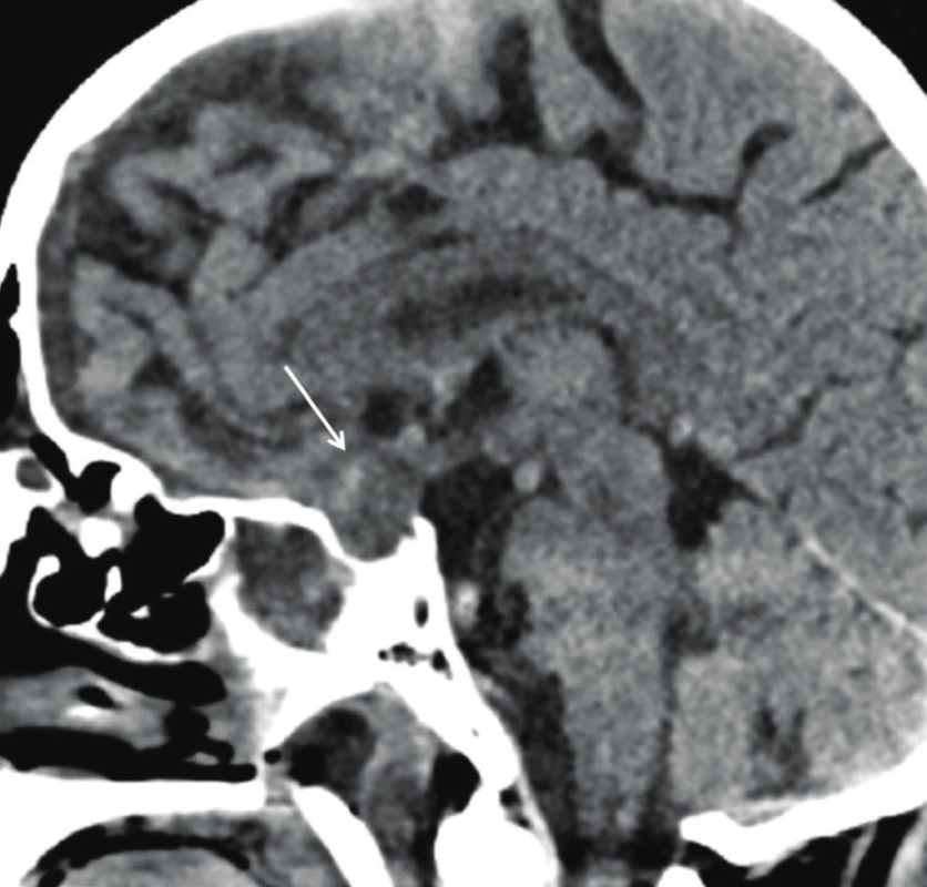 První CT snímek u prezentovaného nemocného. CT, sagitální rekonstrukce, šipka ukazuje rozsáhlou expanzi v oblasti tureckého sedla s propagací supraselárně