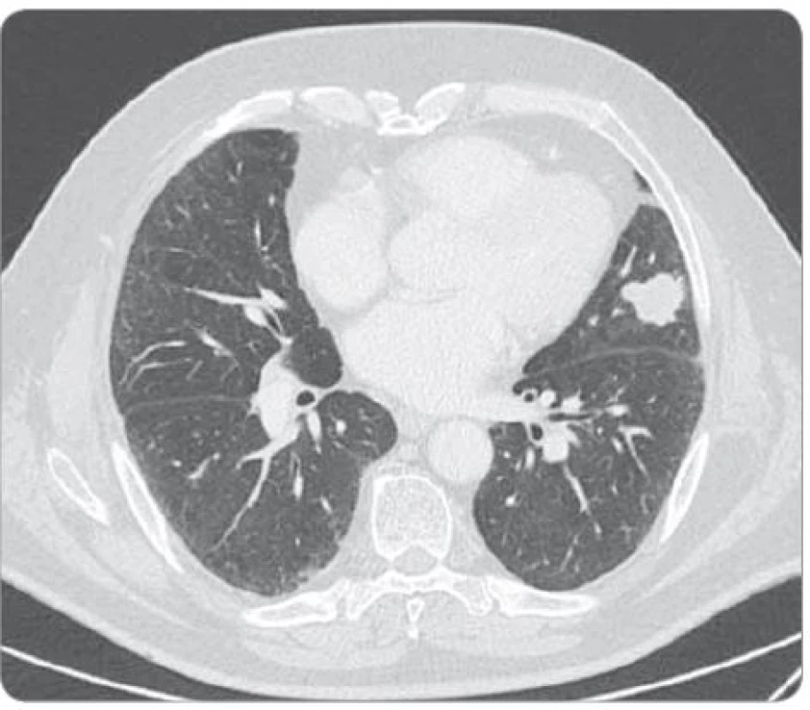 Nález bez známek plicní fibrózy s metastatickým postižením plic (prosinec 2014).