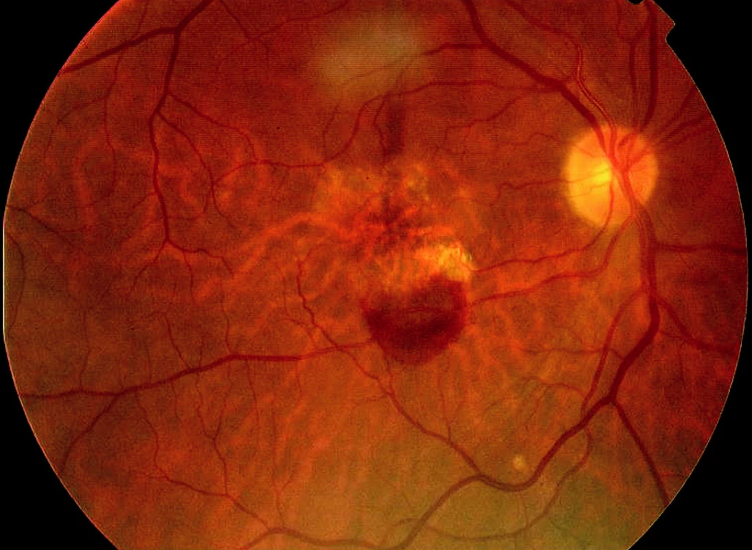 Barevný snímek fundu pravého oka pacienta před FTV/RIV