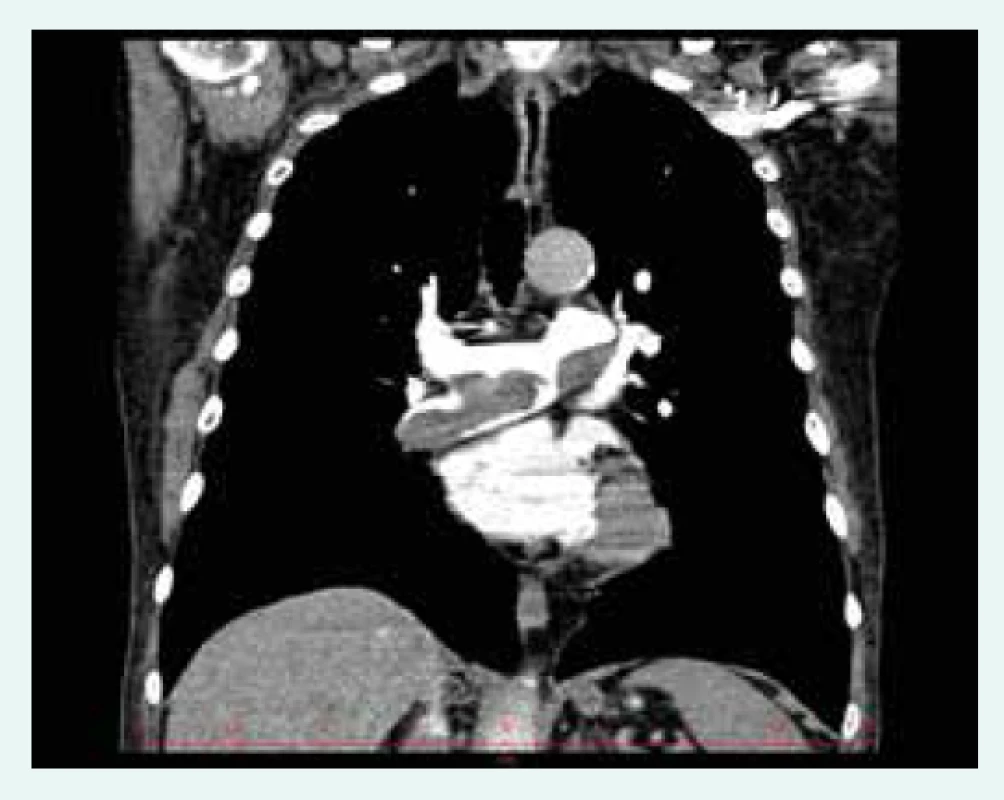 CT angiogram zobrazující objemný obtékaný
trombus v pravé větvi plicnice u nemocného
s chronickou tromboembolickou plicní
hypertenzí