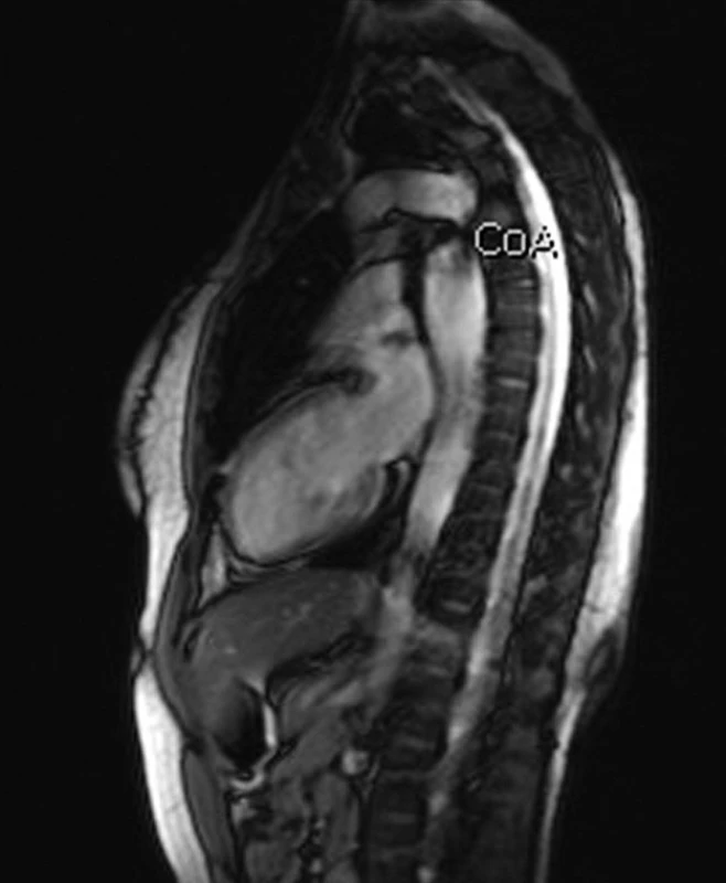 MRI hrudní aorty – koarktace aorty nově diagnostikovaná u 29leté pacientky před IVF (archiv autorů).
Fig. 6. MRI of thoracic aorta – coarctation of aorta diagnosed in a 29-year female patient before IVF (authors’ archive).