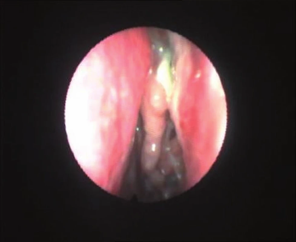 Nosní dutiny s drobnými polypy a patologickou sekrecí ve středním nosním průchodu