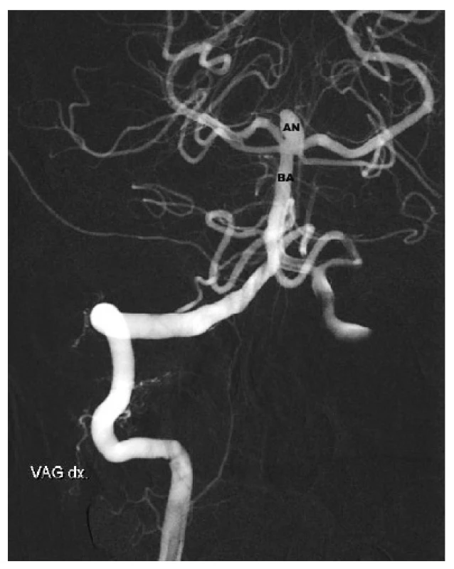 Aneuryzma v terminální části bazilární tepny. AN – Aneuryzm, BA – bazilární tepna
Fig. 5: Basilar tip aneurysma – AN – aneurysm, BA – basilar artery