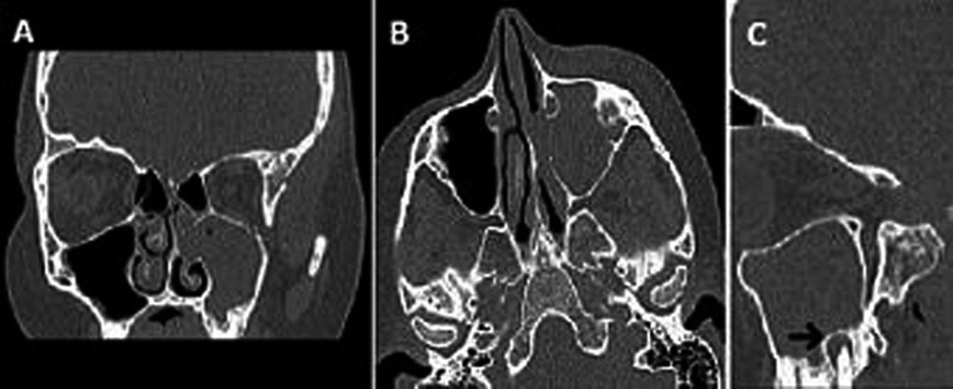 Koronární (A), axiální (B) a sagitální (C) projekce na CT VDN u pacientky s levostrannou odontogenní (černá šipka) akutní rinosinusitidou a levostrannou orbitocelulitidou (den 0 – předoperační CT)