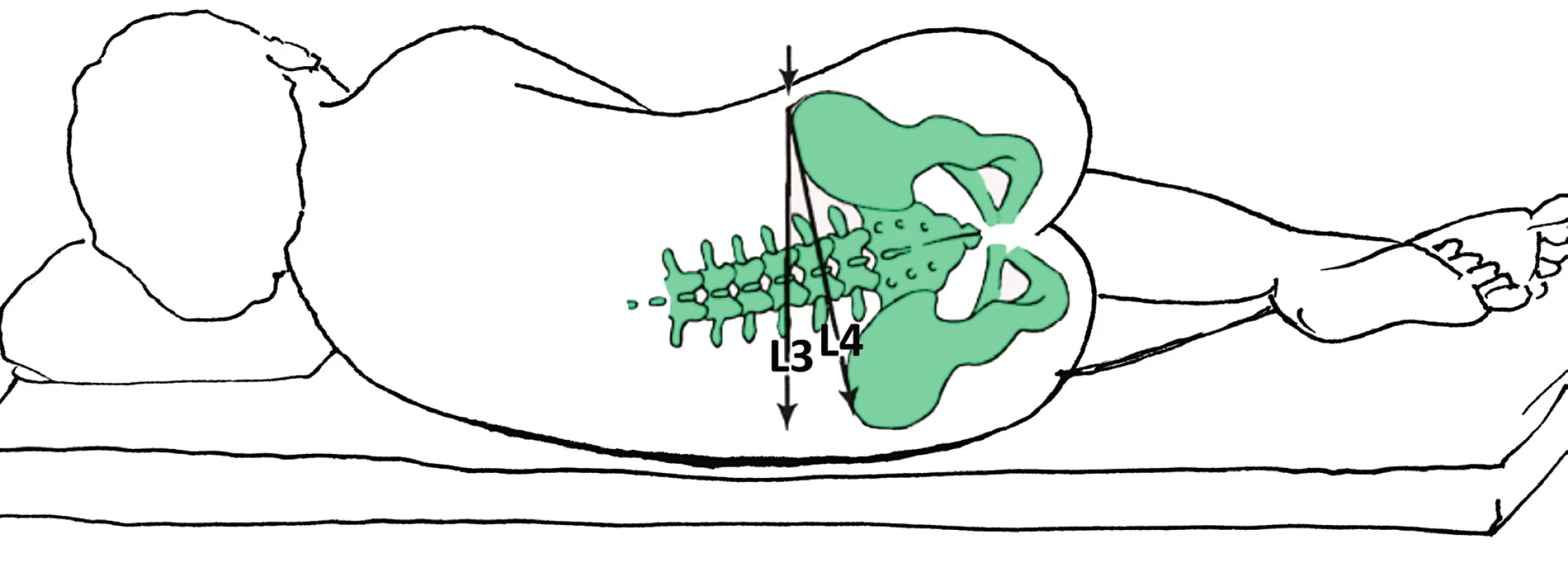 Projekce spojnice obou iliakálních krist u ležící těhotné ženy