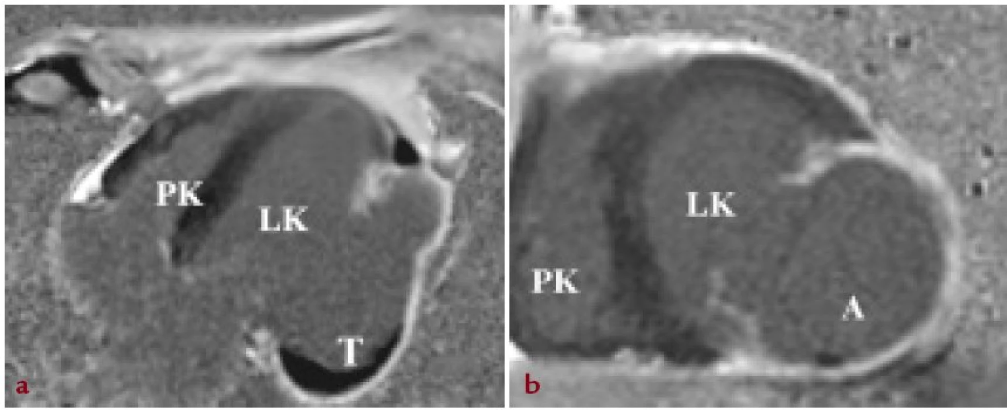 Zobrazení magnetickou rezonancí srdce. A: 4dutinová projekce na dlouhou osu levé komory srdeční s patrným objemným aneuryzmatem (A) ztenčené laterální stěny levé komory srdeční v kinematických sekvencích (TrueFISP CINE) s dyskinezí uvedených segmentů a patrným nástěnným trombem v bazálních segmentech aneuryzmatu (T). V kontrastním zobrazení (Gadolinium- DTPA) patrné pozdní sycení stěny v celém rozsahu aneuryzmatu odpovídající transmurální jizvě. B: zobrazení levé komory srdeční v krátké ose.