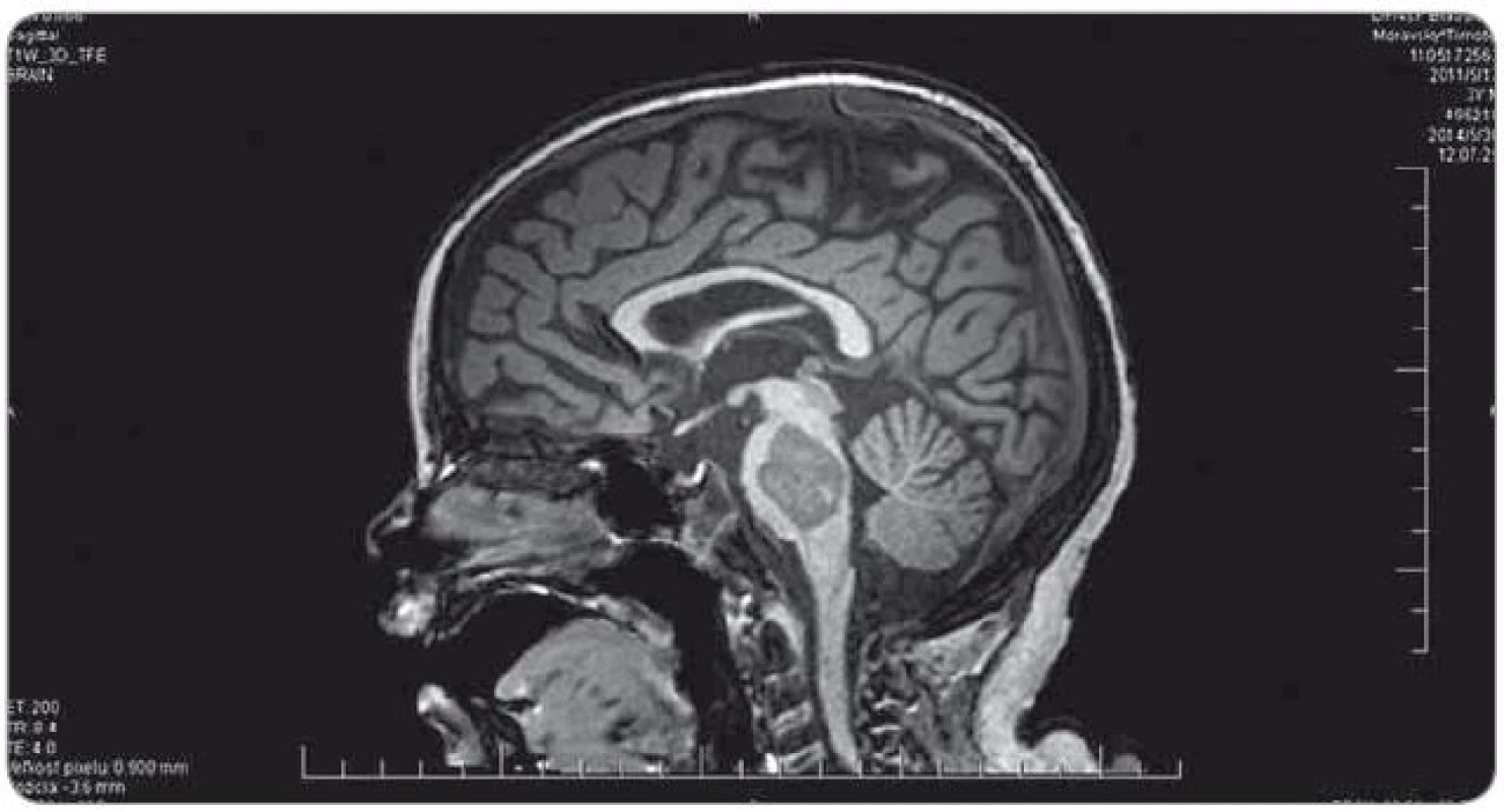 Kontrolné MRI mozgu po ukončení indukčnej chemoterapie (30. 5. 2014).