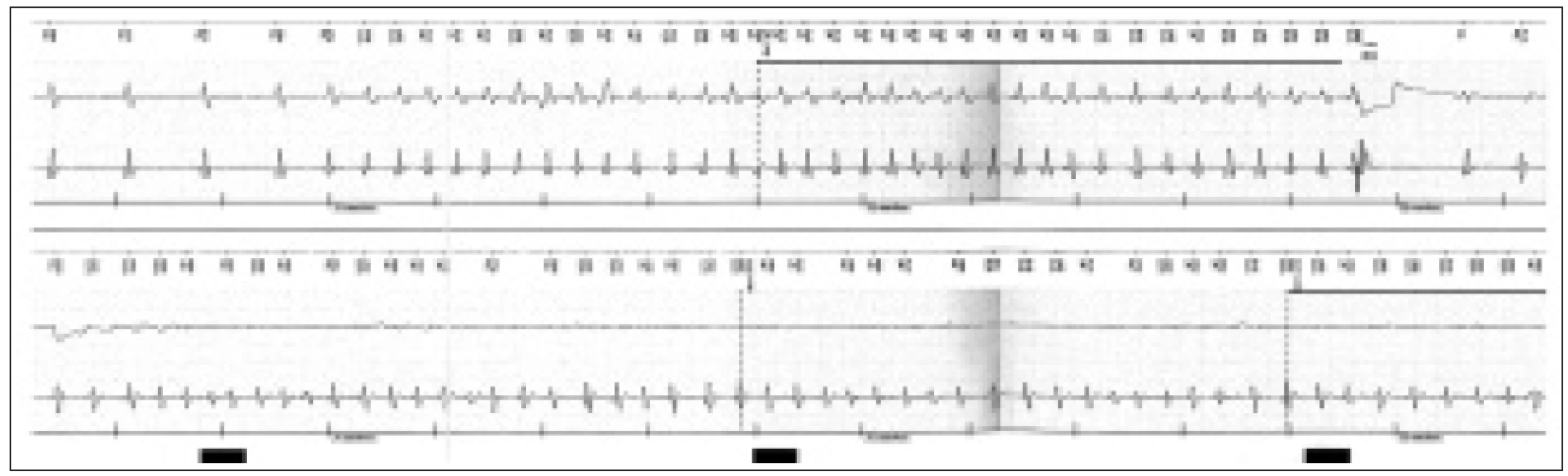 Výpis z paměti ICD – v úvodu sinusový rytmus, následující komorová tachyarytmie detekována přístrojem v zóně VF – po nabití přístroje vydán defibrilační výboj s terminací tachykardie.
