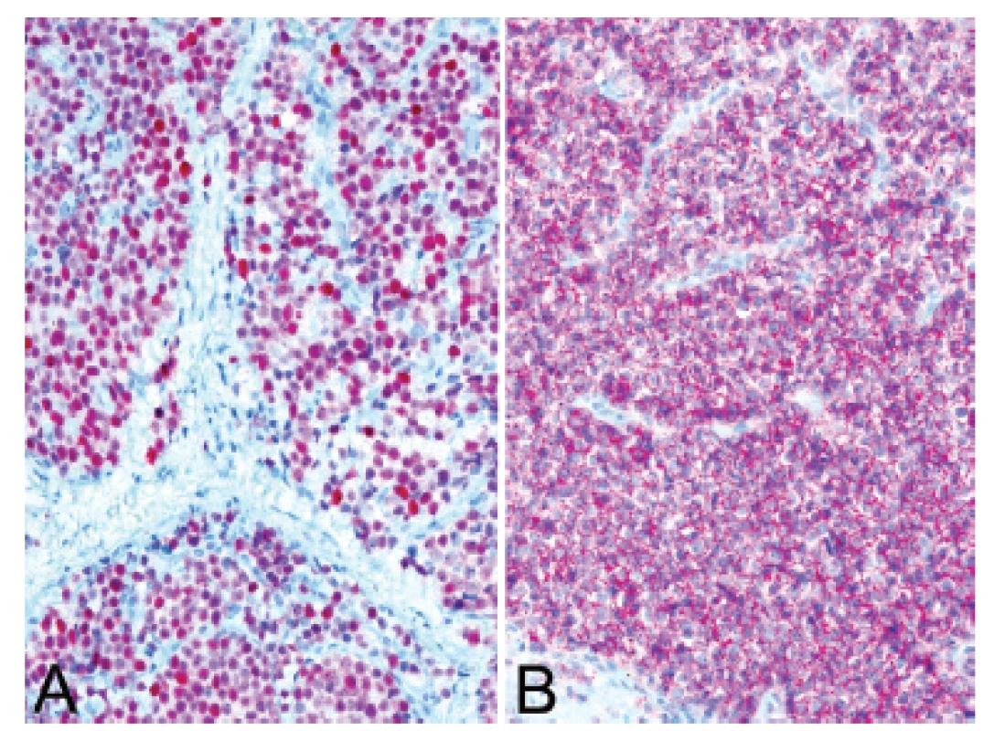 Kazuistika &lt;b&gt;3&lt;/b&gt;. Silná a difúzní pozitivita protilátek NKX2.2 (A) a CD99 (B) v kontextu histologického obrazu favorizovala diagnózu Ewingova sarkomu (IHC, 200x).