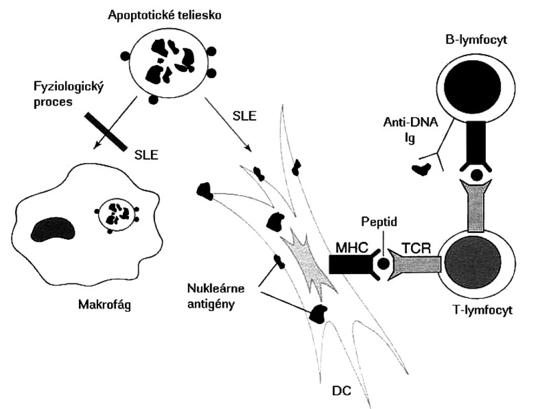 Možný mechanizmus etiopatogenézy pri SLE Pri SLE sa nedostatočne odstraňujú apoptotické telieska, čo umožní dendritovým bunkám vo zvýšenej miere prezentovať nukleárne antigény. Dendritové bunky aktivujú T-lymfocyty, ktoré potom kooperujú s B-lymfocytmi a stimulujú ich, aby produkovali autoprotilátky s následným vývojom zápalových procesov
Fig. 2. Possible etiopathogenetic mechanism of SLE In SLE, apoptotic bodies are not removed sufficiently and consequently, dendritic cells can present nuclear antigenes to a greater extent. Dendritic cells activate T lymphocytes which in turn cooperate with B lymphocytes and stimulate them to produce autoantibodies with subsequent development of inflammatory processes