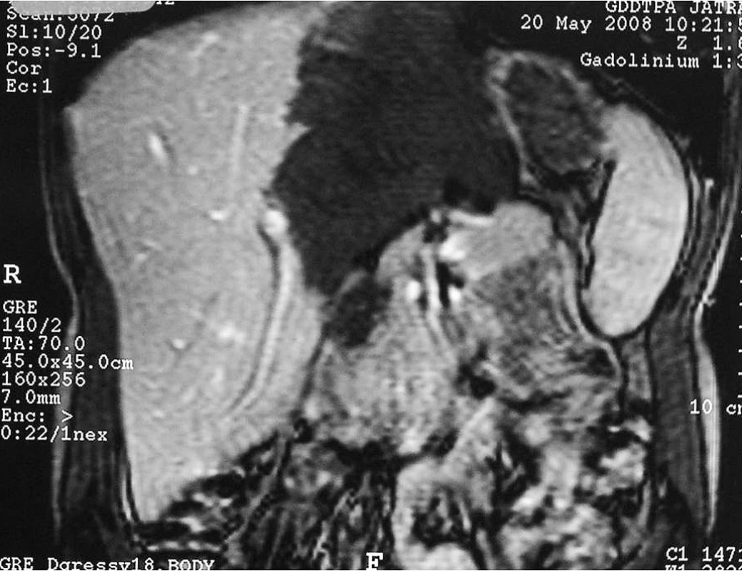 CT jater – postižení levého laloku jater