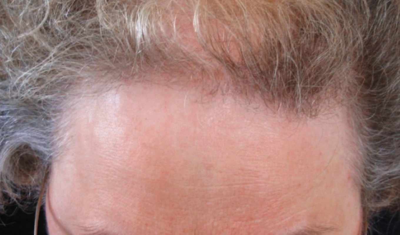 Pokročilá androgenetická alopecie u starší ženy, Ludwig 3 (mezoterapie neperspektivní, prognóza špatná)