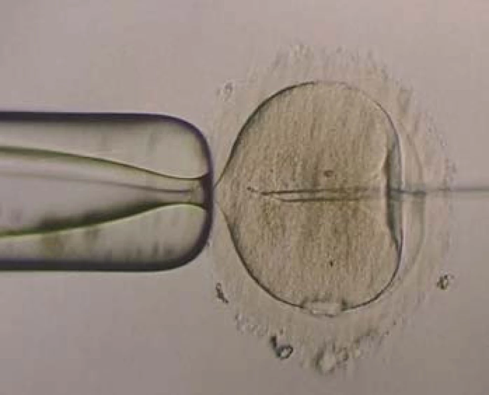 ICSI - spermie na konci pipety.