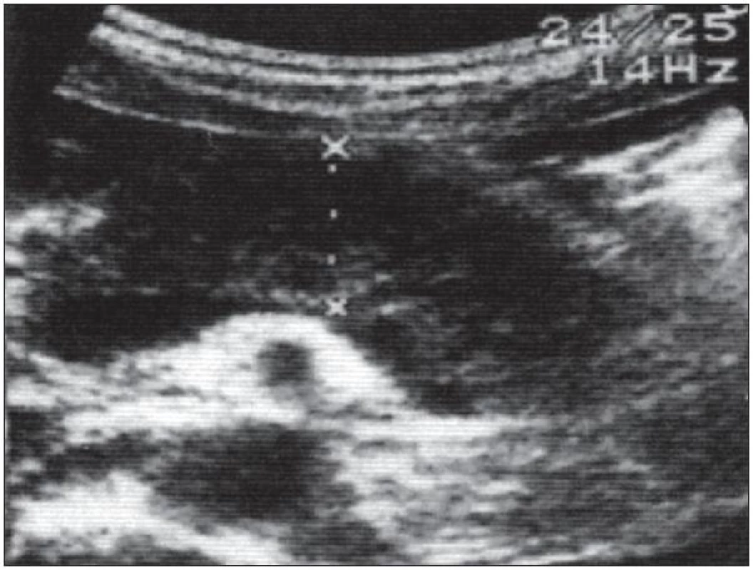Typický klobásovitý tvar celkově zvětšeného pankreatu. Pankreas „prosáklý“, celkově zvětšený, klobásovitého tvaru, bez známek dilatace pankreatického vývodu – charakteristický obraz autoimunitní pankreatitidy.