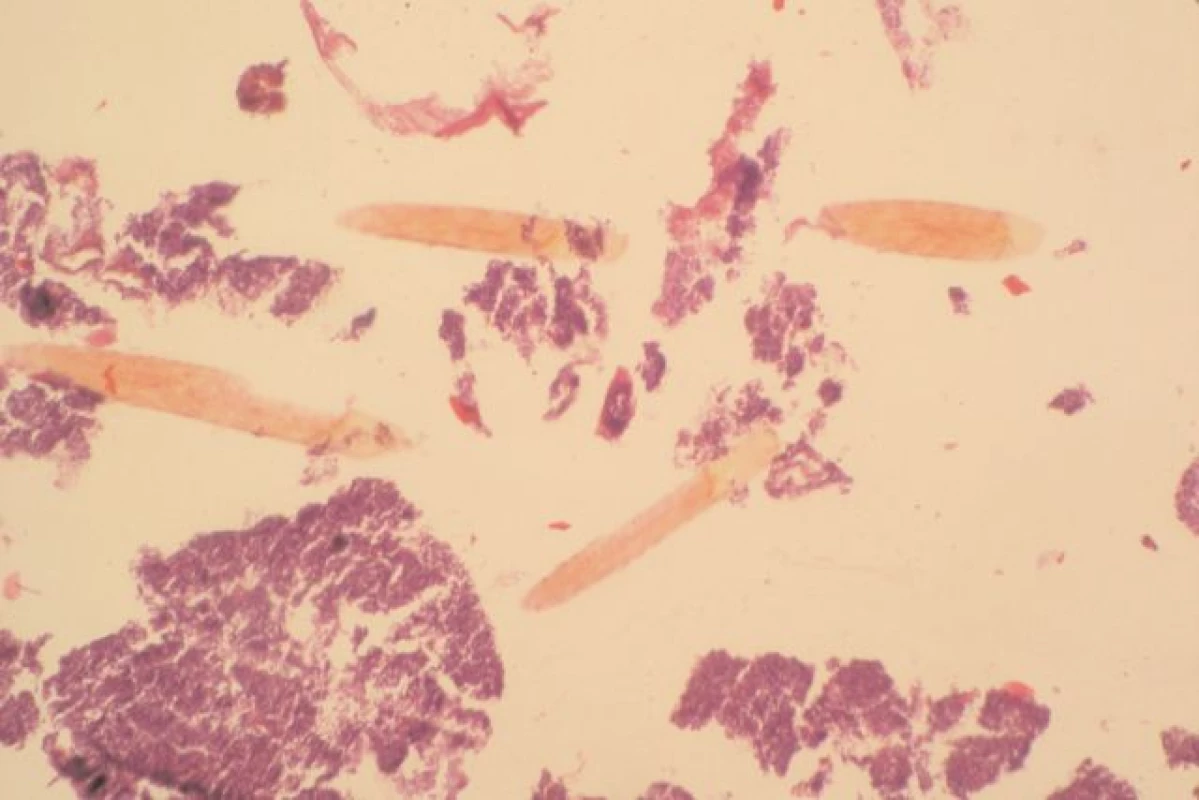 Fragmenty vlasů a chlupů mrtvého v histologickém preparátu. V levé části snímku je na jednom fragmentu vlasu patrné poškození keratofilním organismem (kusadly larvy) (Foto ÚSL 2. LF UK a FN Na Bulovce, Praha)