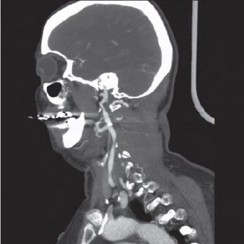 CT angiografie – multiplanární rekonstrukce zobrazující extrakraniální řečiště bez přítomnosti vzduchu.