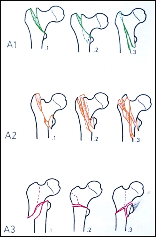 AO klasifikace trochanterických zlomenin A1 – stabilní pertrochanterické zlomeniny; A2 – nestabilní pertrochanterické zlomeniny; A3 – intertrochanterické zlomeniny.
Fig. 4: AO classification of trochanteric fractures A1 – stable pertrochanteric fractures; A2 – unstable pertrochanteric fractures; A3 – intertrochanteric fractures.