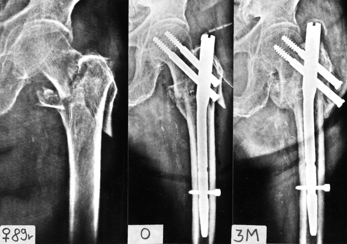 Typ intertrochanterické zlomeniny s hrozící nekrózou krčku femuru: a – intertrochanterická zlomenina se sekundární lomnou linií zasahující do velkého trochanteru a oddělující bazi krčku; b – stav bezprostředně po osteosyntéze; c – rtg 3 měsíce po operaci, zlomenina zhojena, patrný výrazný zkrat krčku vzniklý nejen kompresí fragmentů, ale především resorpcí baze krčku femuru. 
Fig. 14: Type of intertrochanteric fracture with a risc of development of femoral neck necrosis: a – an intertrochanteric fracture with a secondary fracture line involving the greater trochanter and separating the neck base; b – situation immediately after internal fixation; c – radiograph 3 months postoperatively, fracture has healed with a marked shortening of the femoral neck resulting not only from compression of fragments but primarily from resorption of the femoral neck base.