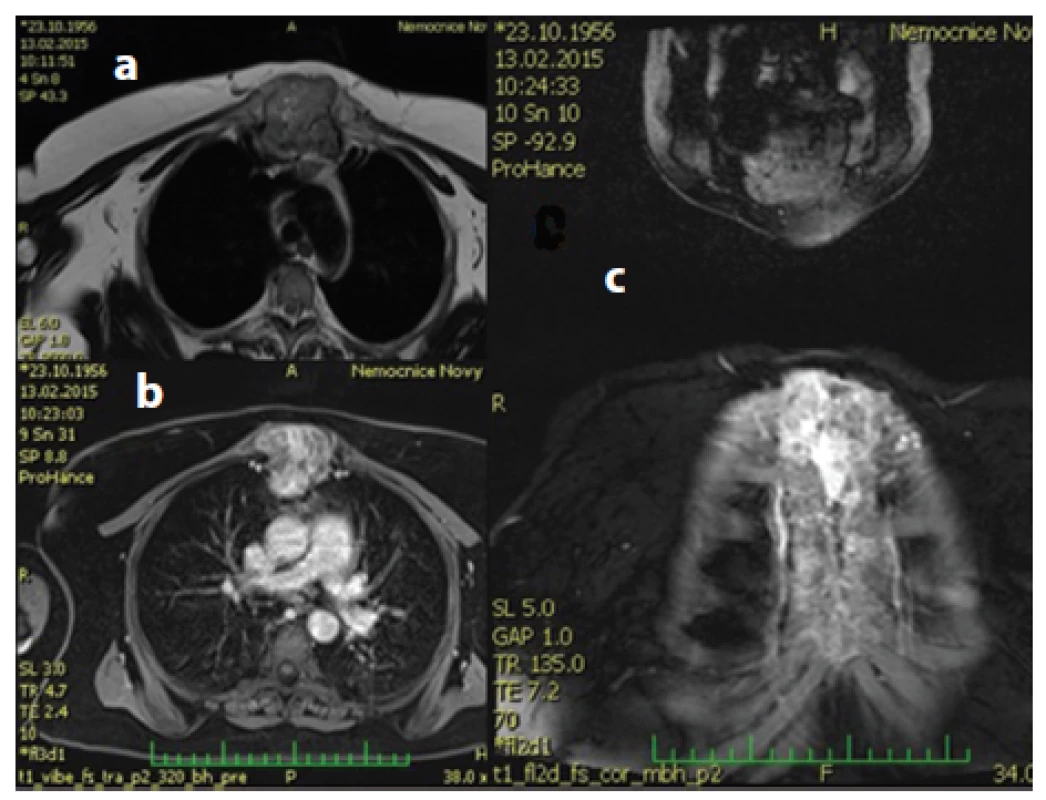 a,b,c: a) Obraz MR T2 axiálního řezu zobrazující tumorózní masu o vel. 58x57x100 mm; b) MR T2 axiální řez po aplikaci kontrastu; c) MR koronární řez s metastázou spotřebovávající prakticky celé sternum.
Fig. 1a,b,c: a) Axial section of T2 MRI view showing a tumor mass measuring 58x57x100 mm; b) Axial section of T2 MRI with contrast; c) Coronary section of MRI view showing metastasis almost completely filling the sternum.