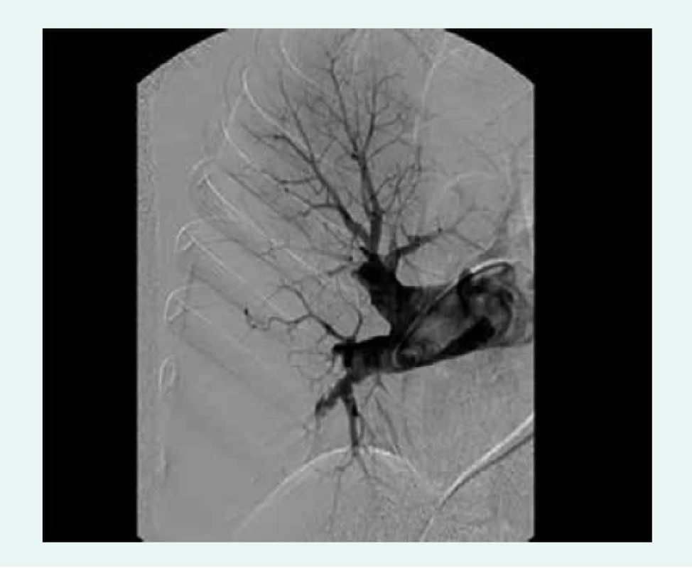 Angiogram zobrazující anatomicky operabilní
nález u nemocného s chronickou
tromboembolickou plicní hypertenzí