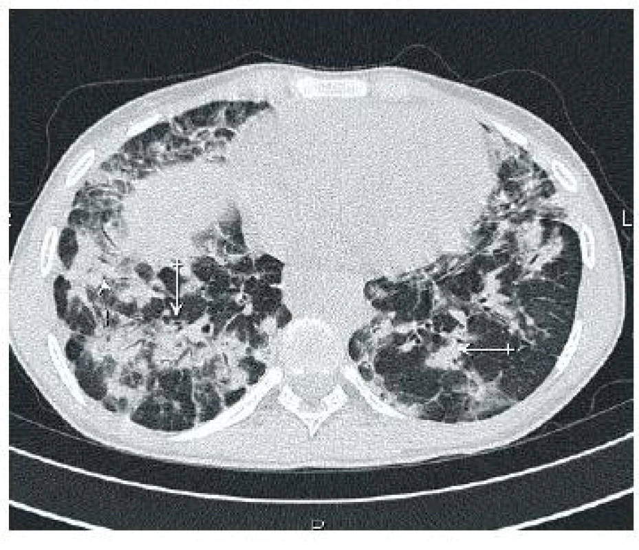 Histologicky nález na pomezí sarkoidózy x GLILD (granulomatózně-lymfocytární intersticiální plicní nemoc)