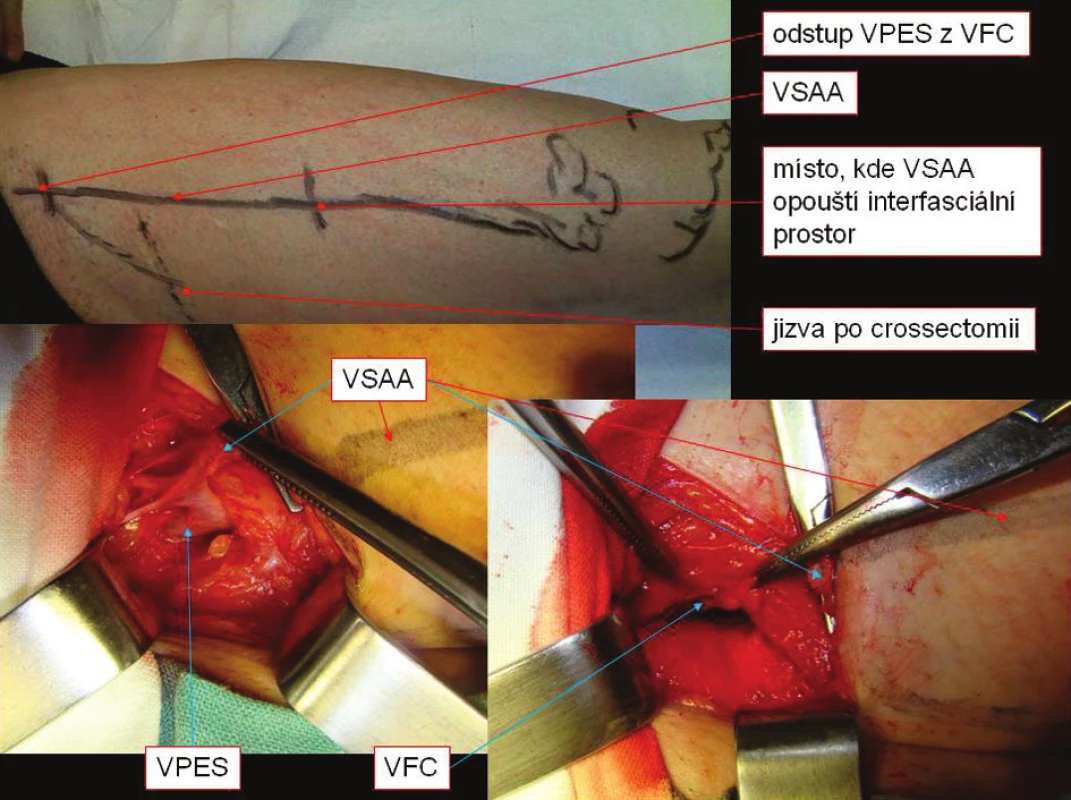 Recidiva varikozit z VPES samostatně ústící do VFC
Fig. 6. Relapses of VPES varicosities, VPES emptying into VFC